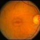 Cone Dystrophy